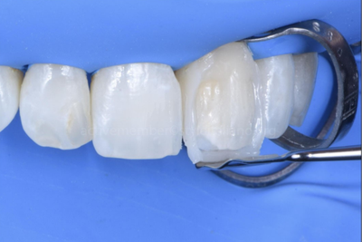 Resinas FGM