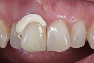 Cementos Dentales FGM